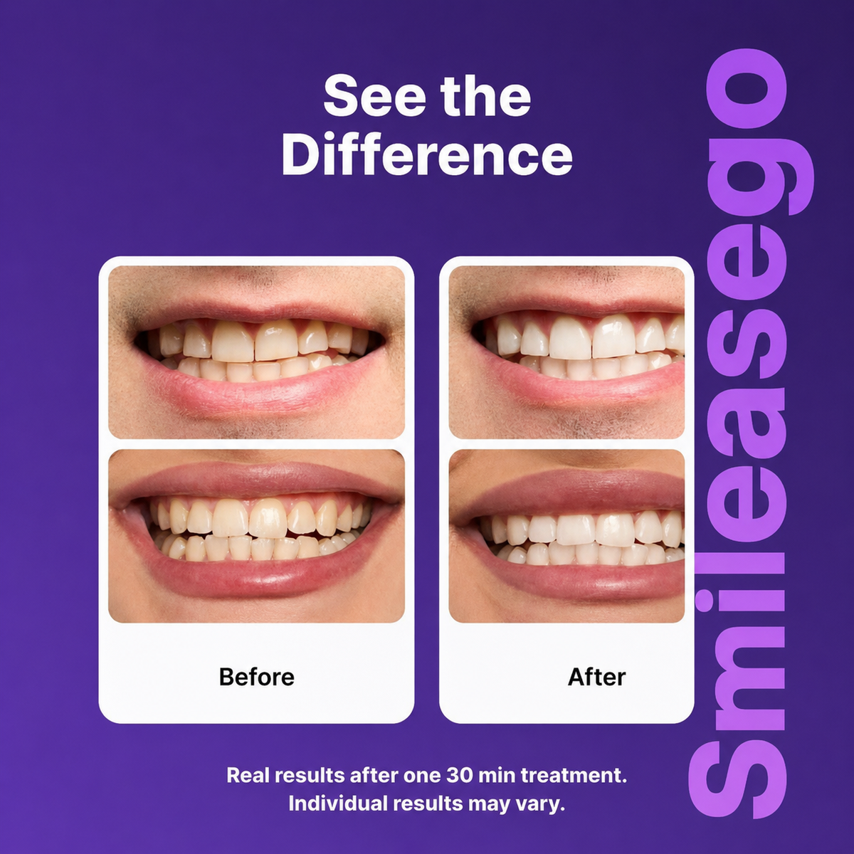 smileasego Purple Teeth Whitening Strips – Peroxide-Free Whitening for Sensitive Teeth